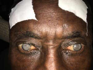 bilateral dense cataracts in patients
